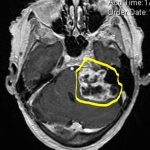 גידול ענק לרחל - בת 97 - תמונה MRI לפני הניתוח