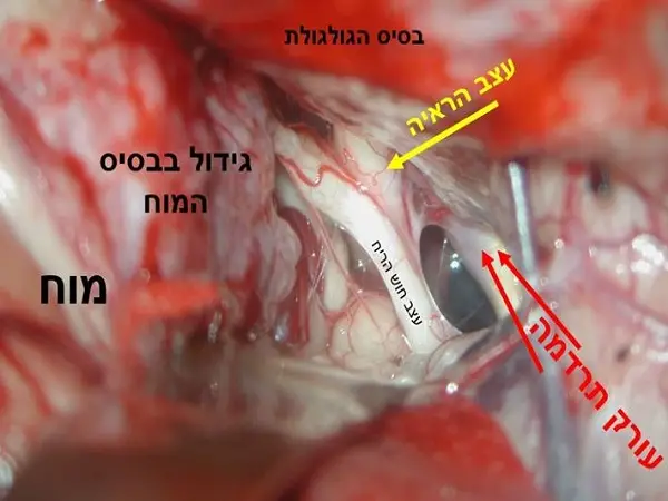 תמונה-של-עצב-הראייה-דרך-מיקרוסקופ-כירורגי