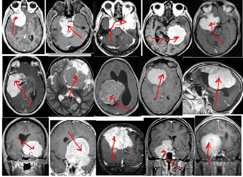 גידולי מוח בצילומי MRI ראש