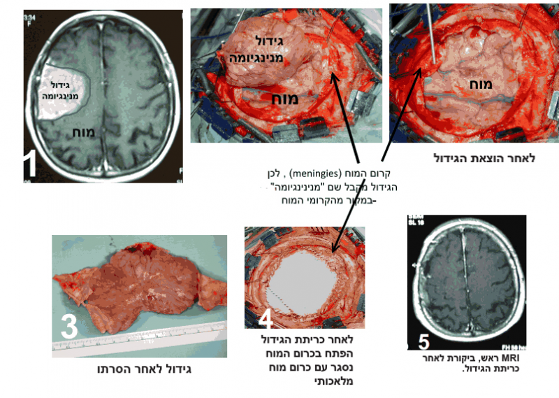 הסרת מנינגיומה