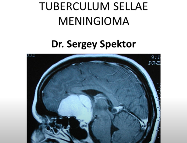 TUBERCULUM SELLA EMENINGIOMA
