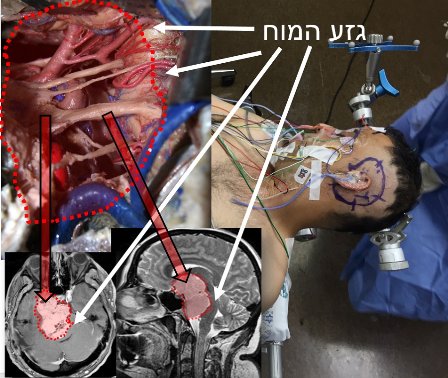 גידול-הנמצא-מתחת-לגזע-המוח