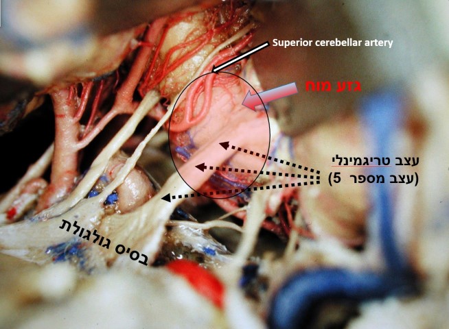 מה-כואב-בנויראלגיה-טריגמינאלית