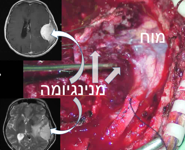 קו-הפרדה-נעלם-בהדרגה
